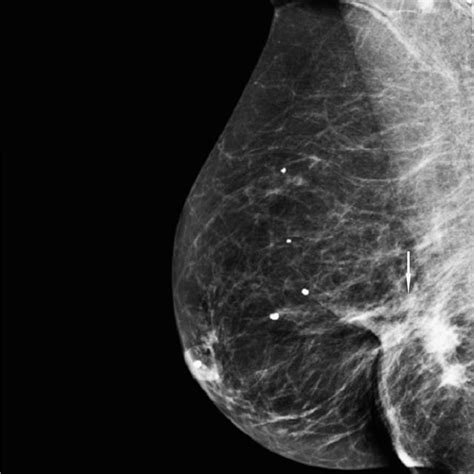 spot compression test|is spot compression mammograms painful.